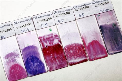 Cervical smear slides - Stock Image - C002/9713 - Science Photo Library