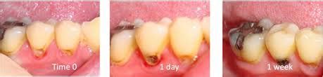 Silver Diamine Fluoride in Dunedin FL - Preventing Tooth Decay