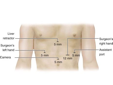 Laparoscopic Collis Gastroplasty and Fundoplication | Thoracic Key