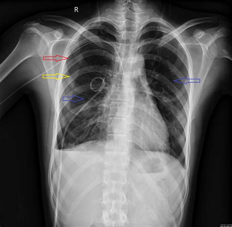 Cureus | Simultaneous Bilateral Spontaneous Pneumothorax: A Rare ...