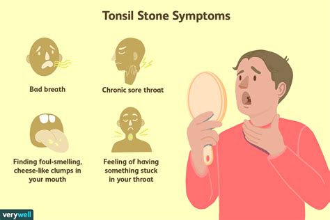 What Are Tonsil Stones? Symptoms, Causes, and Removal