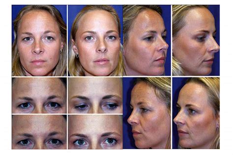 Preventative Botox Twins Study: Botox in Your 20’s and 30’s - Smooth Synergy Medical Spa & Laser ...