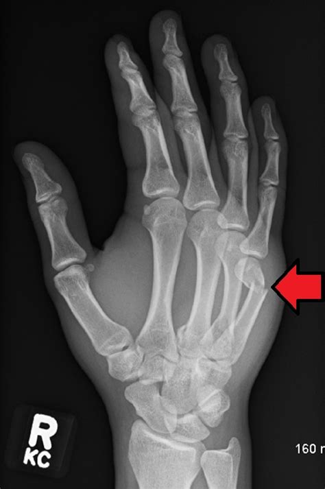 Neck of 5th Metacarpal Fractures – EMbeds.co.uk