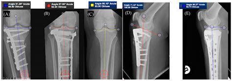 Medicina | Free Full-Text | Malunion of the Tibia: A Systematic Review