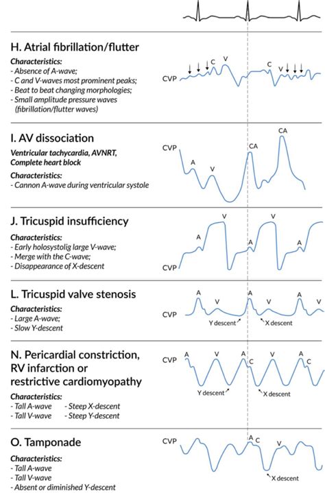 CVP Waveform Emergency Nursing, Central Venous Pressure,, 51% OFF