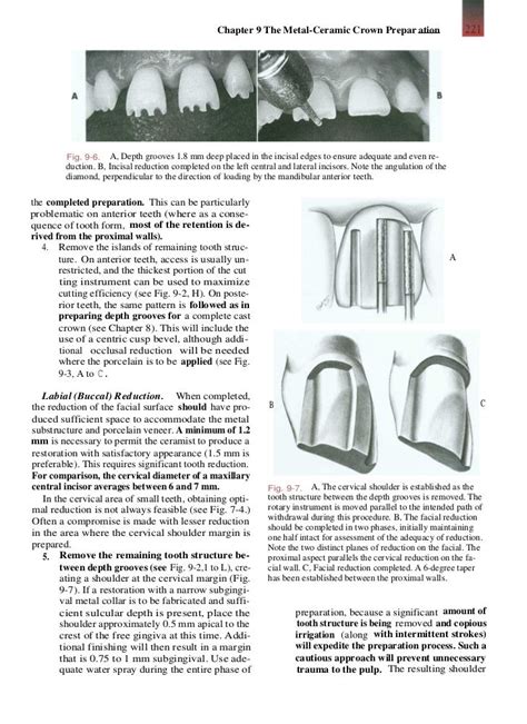 The metal ceramic crown preparation