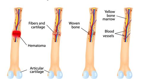 What is the Bone Healing Process? - Dr TDR Reddy