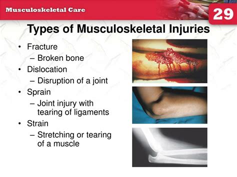 PPT - 29: Musculoskeletal Care PowerPoint Presentation, free download - ID:771866