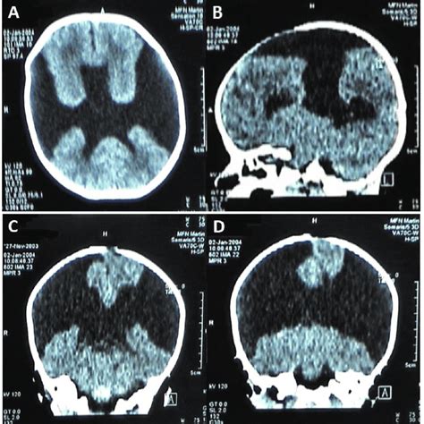 CT examination of the infant with schizencephaly. | Download High ...