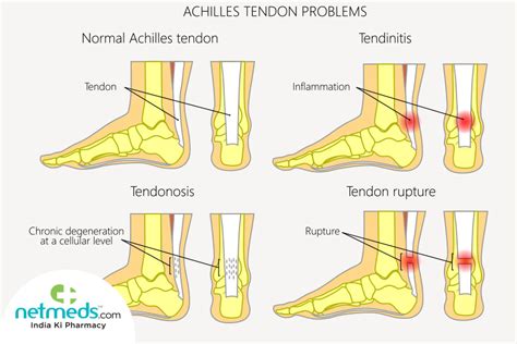 Tendinitis: Causes, Symptoms And Treatment