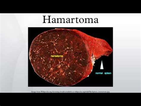 Hamartoma - YouTube