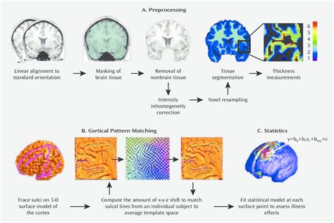 Processing of MRI scans to Assess Cortical Thickness in Patients With ...