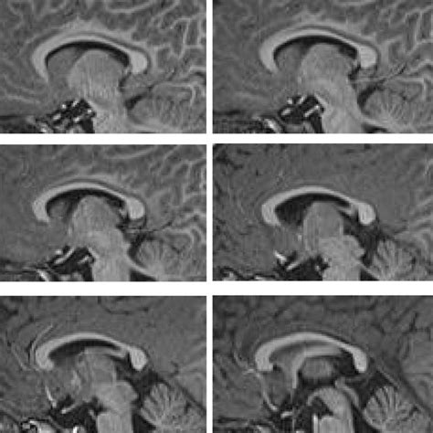 (PDF) The splenium of the corpus callosum: embryology, anatomy, function and imaging with ...