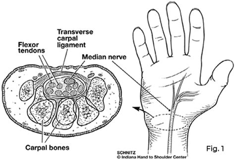 What Is Carpal Tunnel Syndrome? | Patient Education | IHTSC