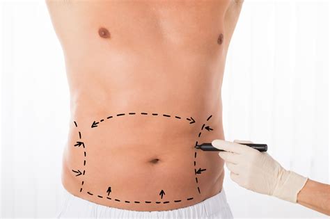 Feel Better Fast: What Are The Best Tummy Tuck Recovery Tips?