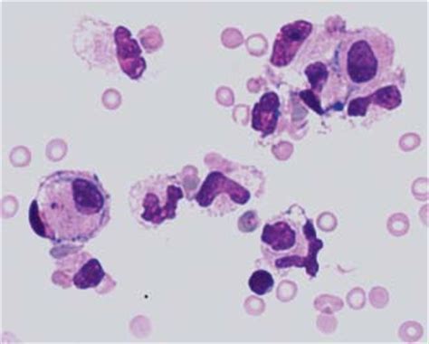 Pathological CSF Cell Findings in Primary and Metastatic CNS Tumors ...