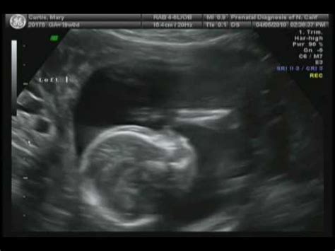 Ultrasound of Identical Twin Boys at 19 weeks - YouTube