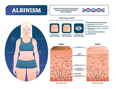 Albinism Diagram