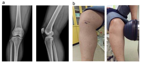 (a) The knee radiography showed Kellgren-Lawrence classification grade ...