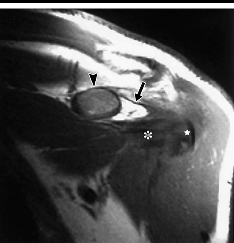 Coracohumeral Ligament Mri