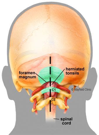 Chiari decompression surgery | Mayfield Brain & Spine | Spinal fluid ...