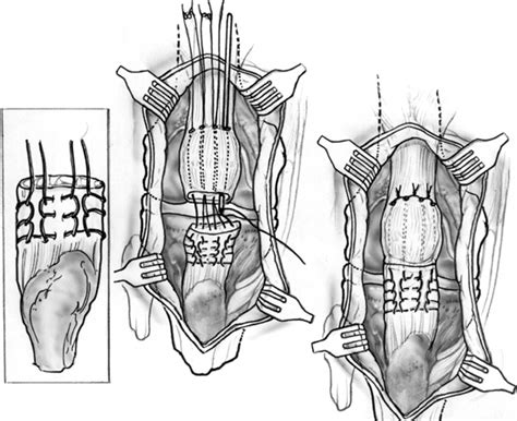 Repair and Reconstruction of Acute and Chronic Patellar Tendon Rupture | Musculoskeletal Key