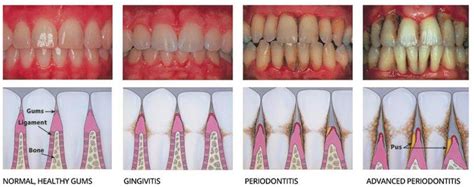 E-Cigs & Oral Health: How Vaping Affects Gums & Teeth – Huff & Puffers