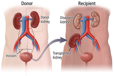 Kidney Transplant; Is A Treatment Used For Kidney Failure - Latest ...