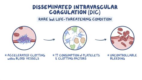 Disseminated intravascular coagulation (DIC): Nursing - Osmosis Video ...