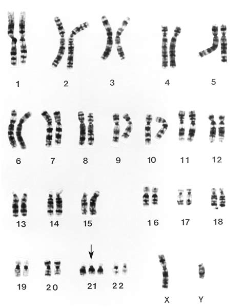 Sindrome di Down (trisomia 21) - Pediatria - Manuali MSD Edizione ...