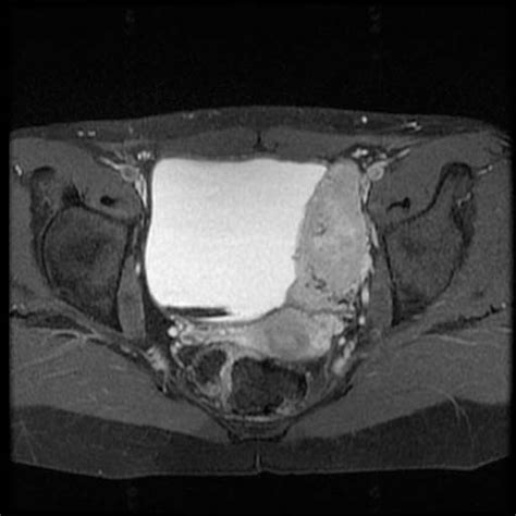 Pheochromocytoma MRI - wikidoc