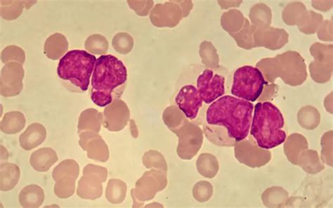 A Closer Look at the Leading Indicators of LGL Leukemia