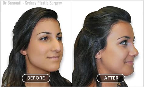 Plastic Surgery Before And After Nose Jobs