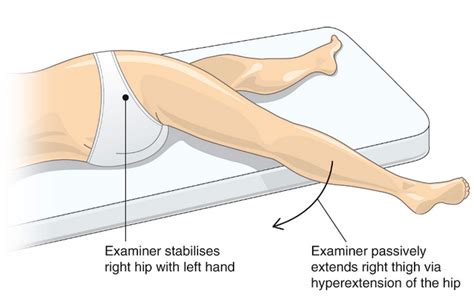 Psoas Sign And Obturator Sign