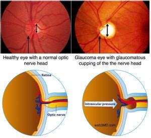 Glaucoma - High Internal Eye Pressure That Causes Vision Loss