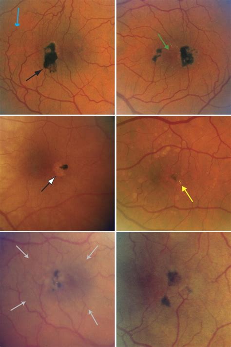 The Prevalence of Macular Telangiectasia Type 2 in the Beaver Dam Eye Study | Ento Key