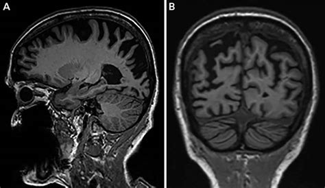 Posterior cortical atrophy causes, symptoms, diagnosis, treatment & life expectancy