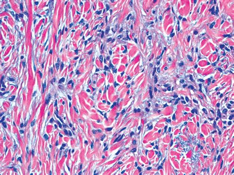 Pathology Outlines - Benign fibrous histiocytoma (superficial)