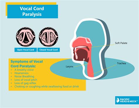 Vocal Cord Paralysis - Pacific Head & Neck