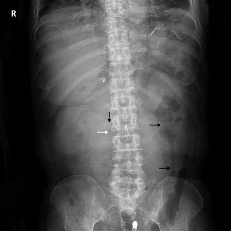 Radiographic Findings of a Ruptured Abdominal Aortic Aneurysm | Circulation