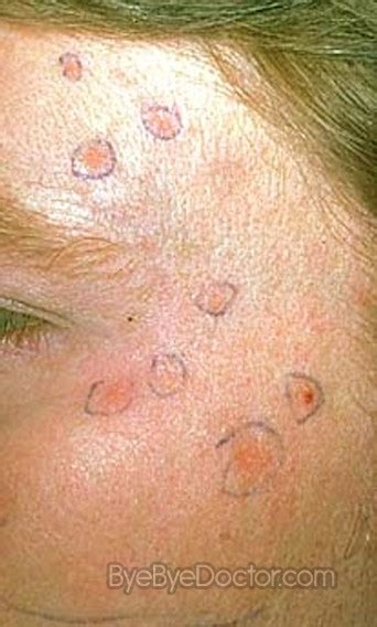 Keratosis; Keratoma; Keratoderma Blennorrhagicum; Keratosis Blennorrhagica