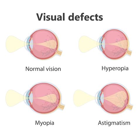 Premium Vector | Ophthalmic poster, eye defects.