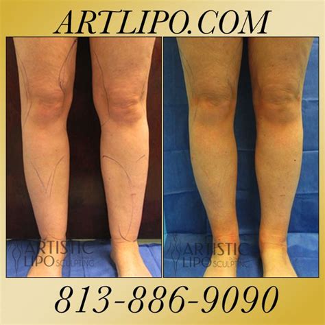 Pin on Cankles, Ankles, Calves. The Best Liposuction. Expert Dr. Thomas Su