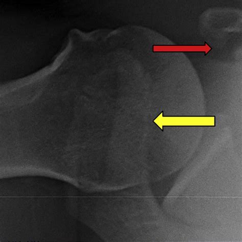 Axillary view of a right shoulder. A coracoid fracture nonunion is once... | Download Scientific ...