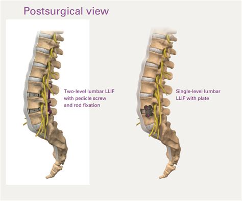 LLIF Spine Fusion | Spine Neurosurgeon Palm Beach County