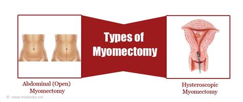 Myomectomy - Indications, Types, Preparation, Procedure & Complications