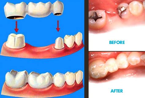 Dental Bridge Procedure