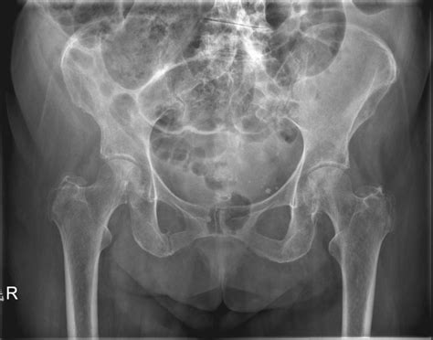 pubic-rami-fracture - RCEMLearning India