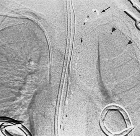 Chylothorax | Pediatric Surgery NaT