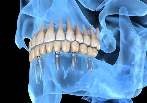 Recovery from Dental Implants » Minnesota Oral & Facial Surgery